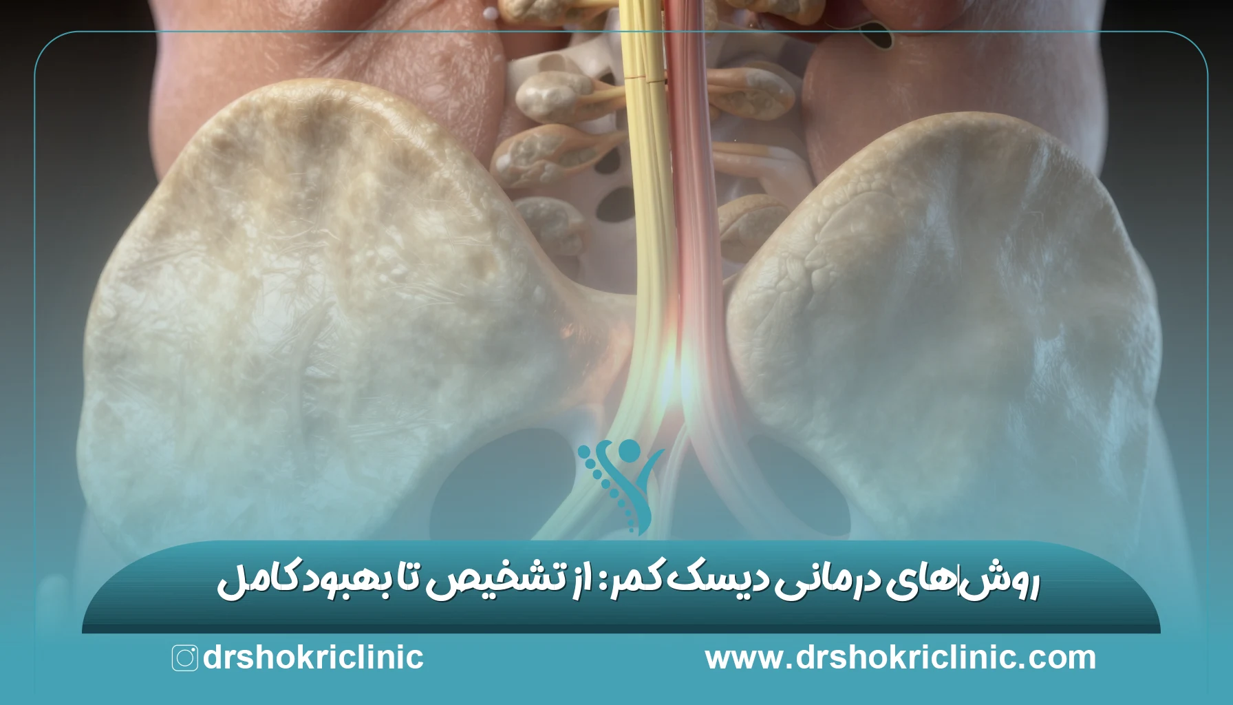 روش‌های درمانی دیسک کمر: از تشخیص تا بهبود کامل