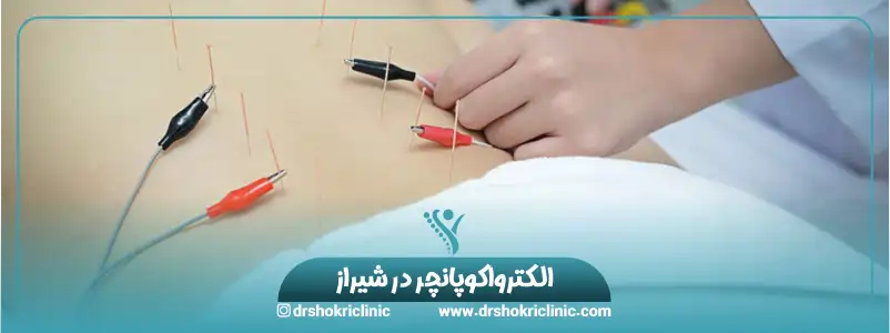 الکترواکوپانچر در شیراز