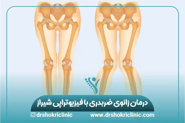 درمان زانوی ضربدری با فیزیوتراپی شیراز