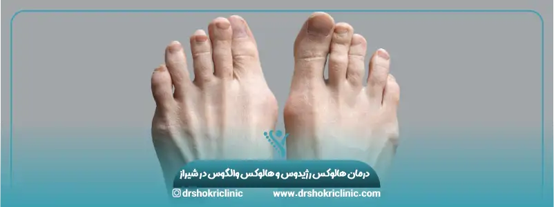 درمان هالوکس رژیدوس و هالوکس والگوس در شیراز 