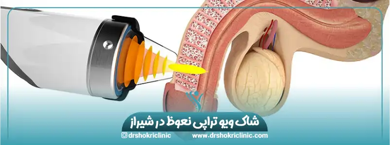 شاک ویو تراپی نعوظ در شیراز