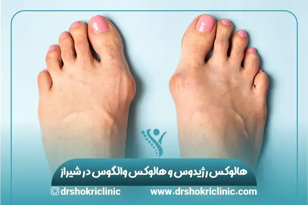 هالوکس رژیدوس و هالوکس والگوس در شیراز