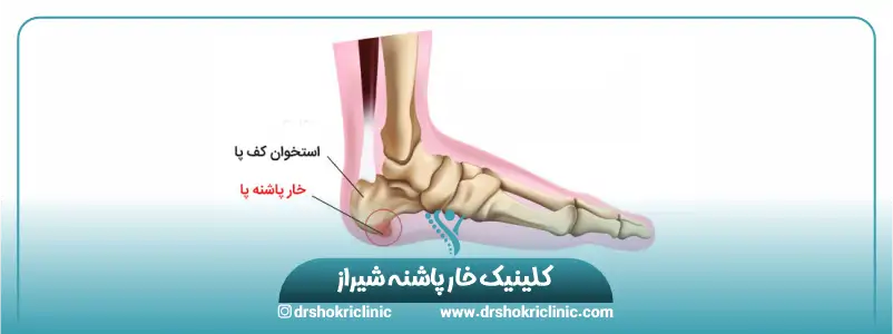 کلینیک خار پاشنه شیراز